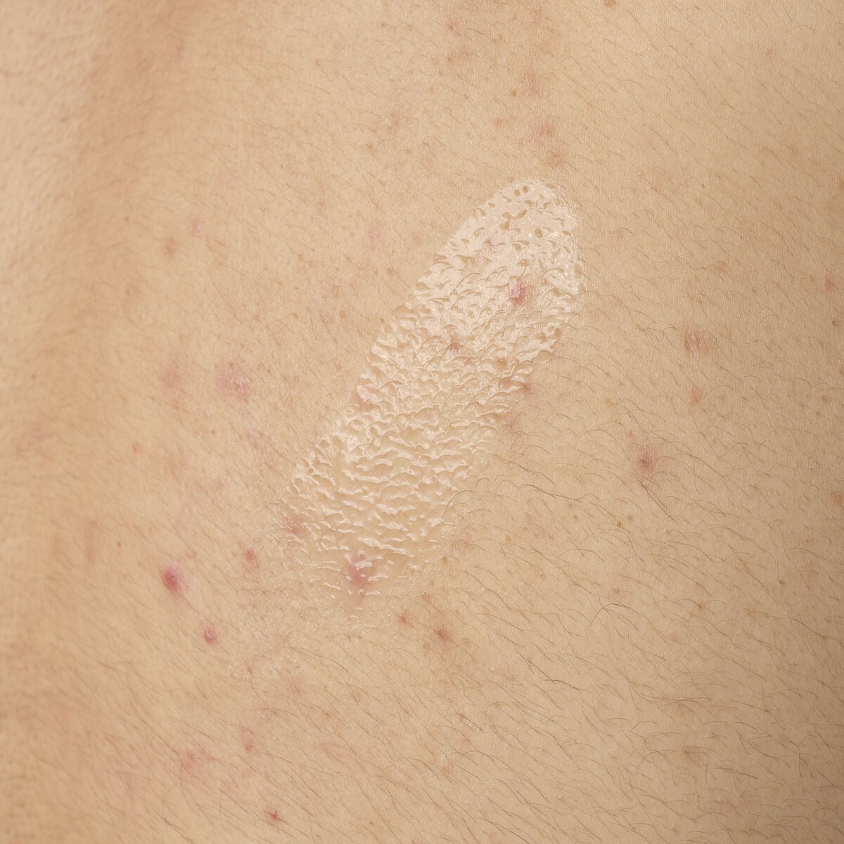 salicylic-acid-0-5-body-serum-v1 ORD-salicylic-acid-05-body-240ml-application.jpg