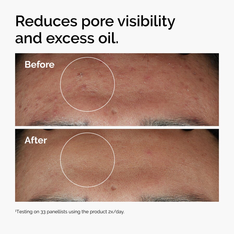 niacinamide-10-zinc-1-u6 ord-niacinamide-zinc-blemish-serum-before-after-pores.jpg