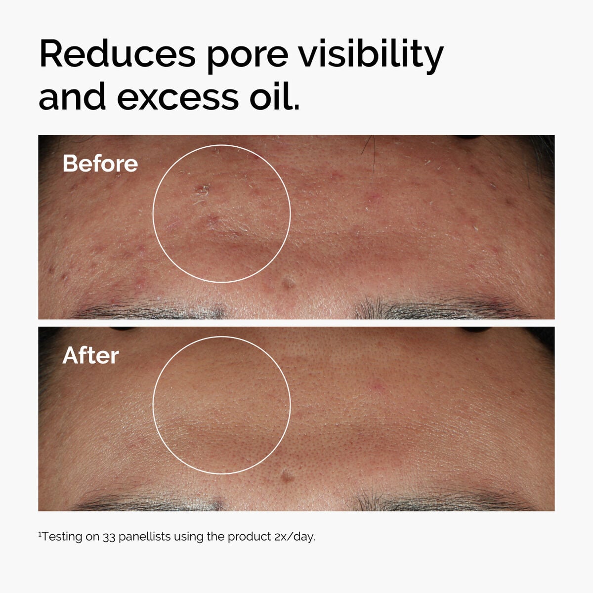 niacinamide-10-zinc-1-u6 ord-niacinamide-zinc-blemish-serum-before-after-pores.jpg