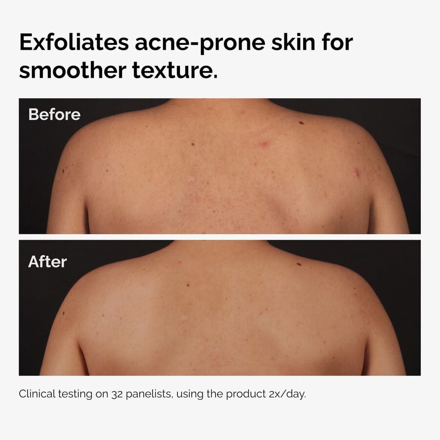 the-body-care-collection-o9 ord-salicylic-acid-body-serum-before-after-graphic-NA.jpg