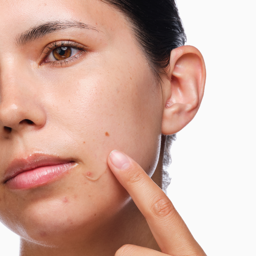 the-acne-set-f9 rdn-the-acne-set-application.png